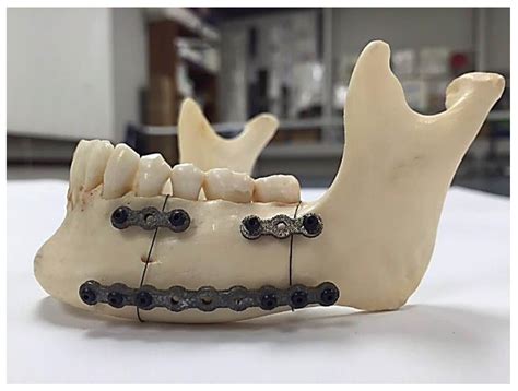 can you box with metal plates in jaw|removing fixation plates after jaw surgery.